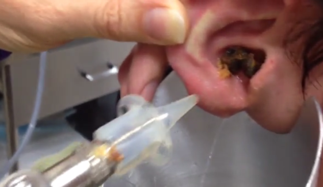 Walgelijk En Toch Blijf Je Kijken Zo Ziet Een Prop Oorsmeer Het Nieuwsblad Mobile