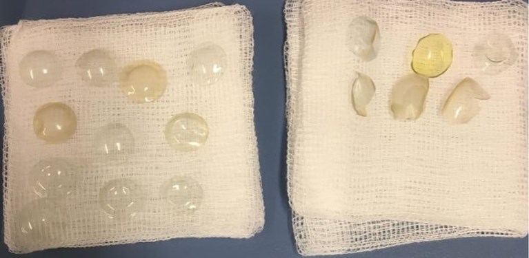Vrouw klaagt over slecht zicht, en dan vinden artsen 27 contactlenzen in haar oog