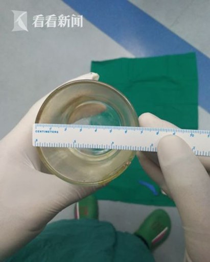Dokters schrikken zich hoedje wanneer ze dit voorwerp in achterwerk van patiënt aantreffen