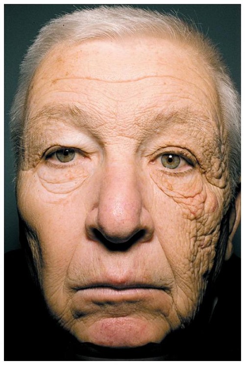 Foto toont wat 28 jaar in de zon met je gezicht doet - Het Nieuwsblad Mobile