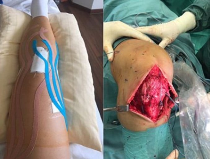Skiester blikt terug op helse revalidatie op weg naar olympisch zilver… met gruwelijke foto van geopereerde knie