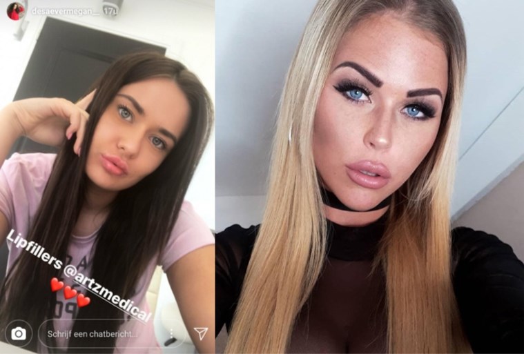 Zorgen over ‘Temptation Island’-deelneemsters die plastische chirurgie promoten