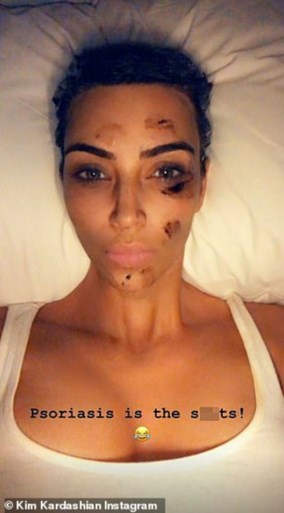 Kim Kardashian deelt eerlijke beelden van haar huidziekte: “Ten einde raad”