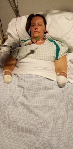 Moeder (33) van twee kinderen slachtoffer van vleesetende bacterie: zo verwoestend dat ze beide knieën, benen en armen verloor