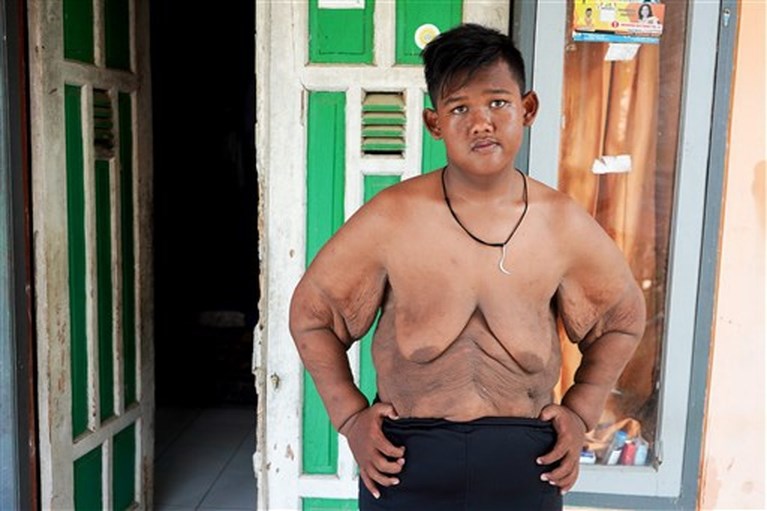 ‘Dikste jongen ter wereld’ valt 100 kilo af: “Ik kan nu voetballen en met vrienden rondhangen”