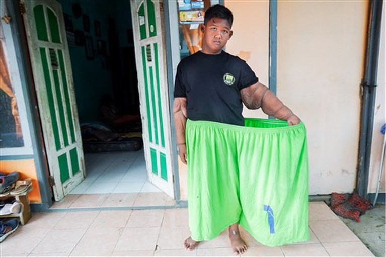‘Dikste jongen ter wereld’ valt 100 kilo af: “Ik kan nu voetballen en met vrienden rondhangen”