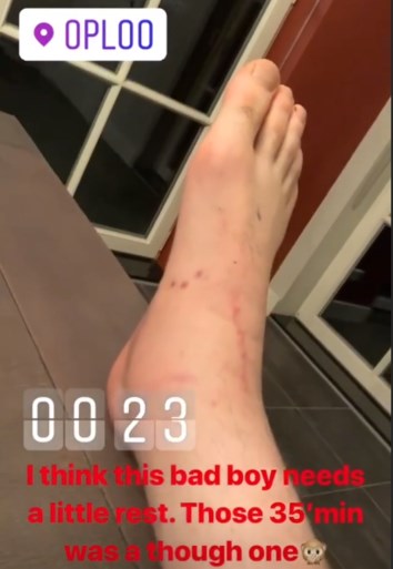 Wereldkampioen motorcross Jeffrey Herlings toont gebroken enkel waarmee hij nog wedstrijd reed (en won!)