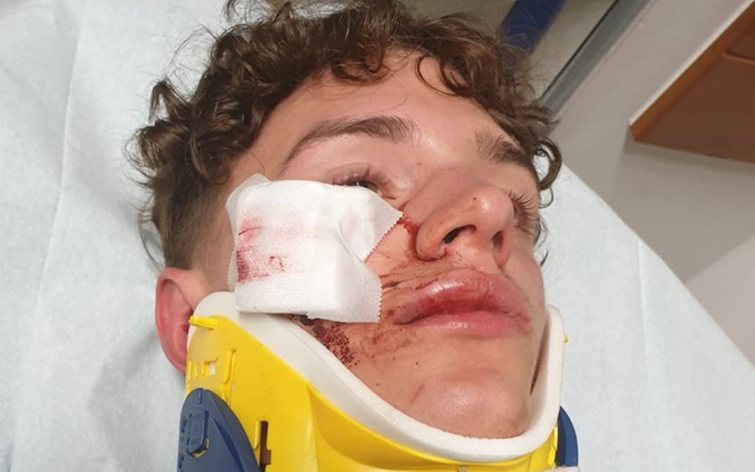 Lennert (15) herstelt van vechtpartij op Chirofuif: “Iemand heeft een boksbeugel gebruikt”