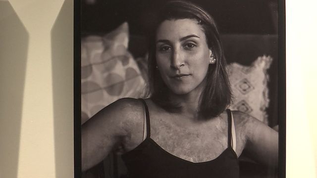 VIDEO. Jonge fotografe toont eigen en andere littekens in tentoonstelling