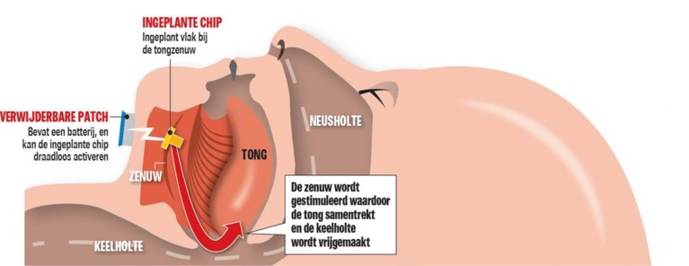 Kleine chip van Belgisch bedrijfje krijgt de snurker stil