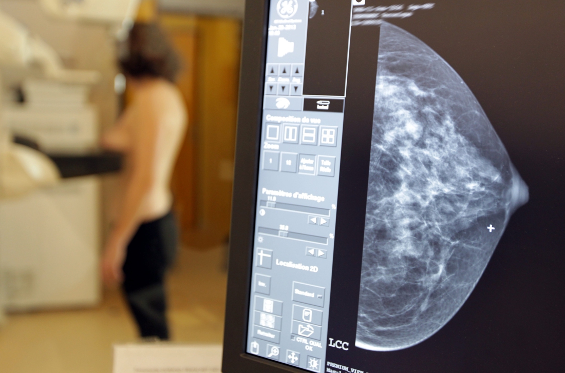 Computer predicts risk of developing breast cancer within two years …