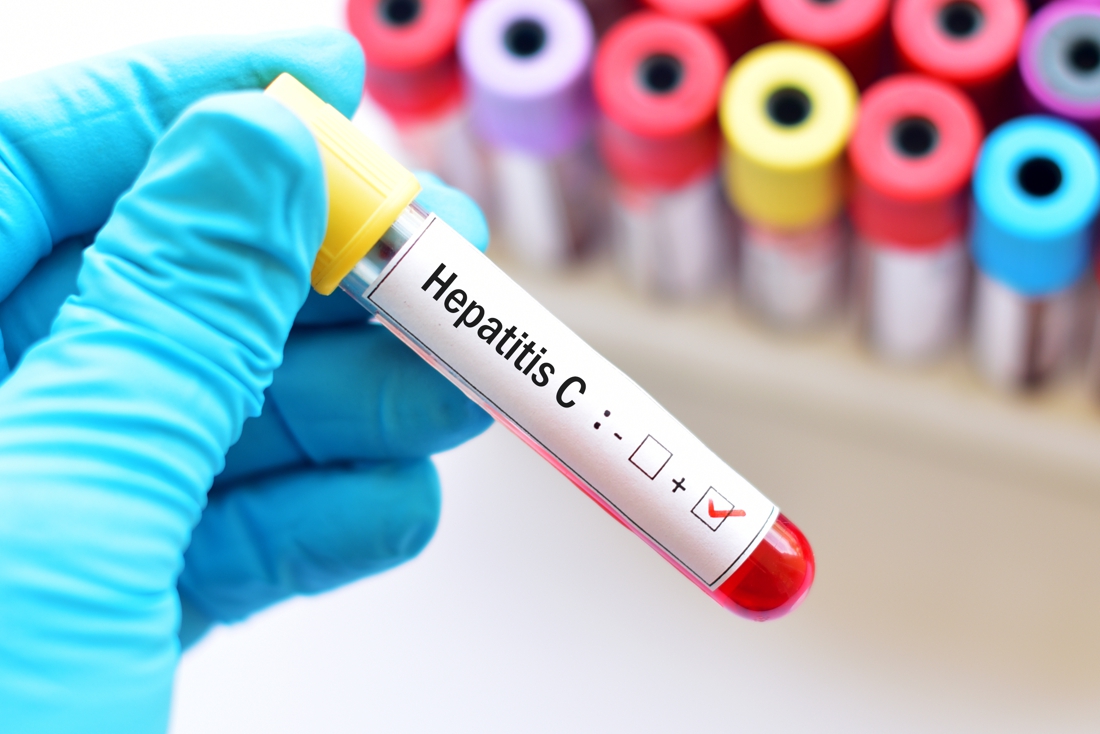 Hepatitis C infections are many times more numerous in Brussels than…