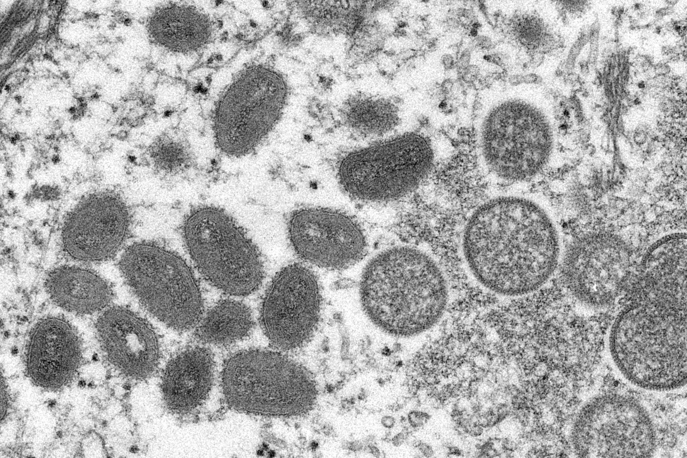 First confirmed case of monkey pox in US, dozen suspected cases in Canada