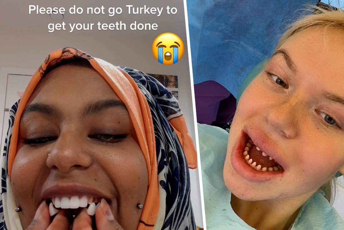 De keerzijde van de 'Turkse tanden-trend': duizenden mensen kampen met | Het Nieuwsblad Mobile