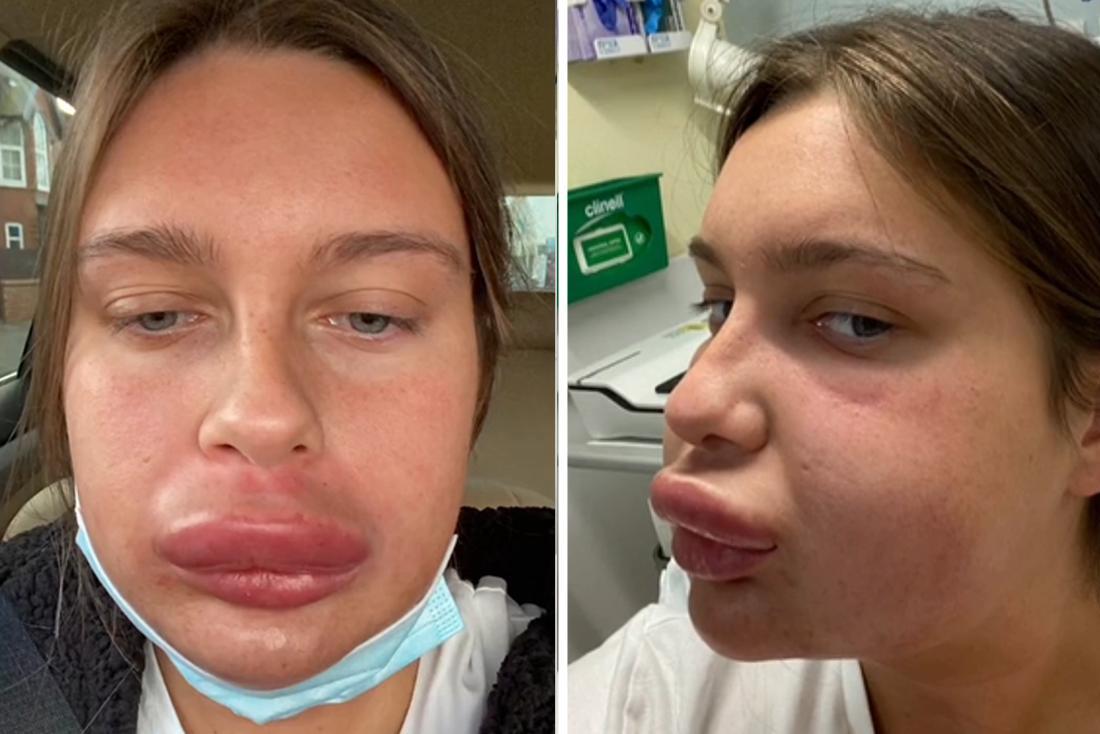 Woman (23) Looks Like ‘Donald Duck’ When She Gets Allergic Reaction While Getting Fillers Removed