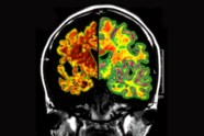 Special Brain Scanner Detects Alzheimer s Disease At A Very Early Stage 