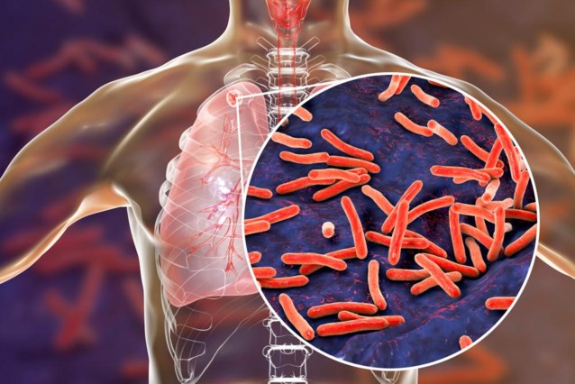 La tuberculose sera bientôt à nouveau la maladie infectieuse la plus meurtrière au monde.  “Les efforts des 14 dernières années annulés”
