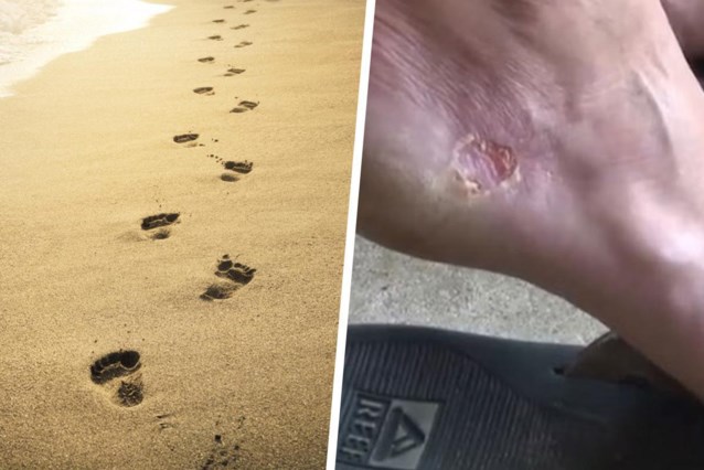 American Hiker Contracts Flesh-Eating Bacteria After Beach Walk: Shocking Diagnosis Revealed