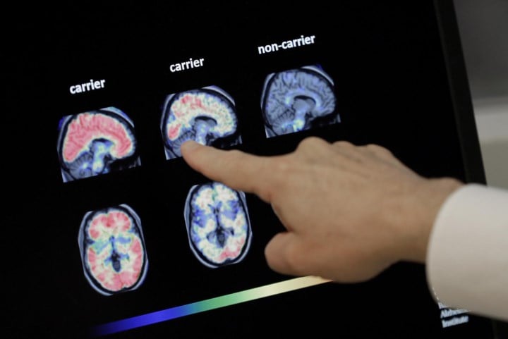 Leuvens biotechbedrijf test nieuw en verbeterd Alzheimermedicijn